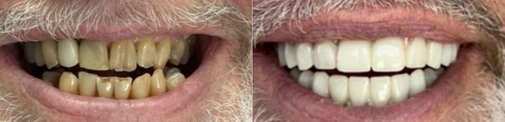 Laurel Bowie Implant and Cosmetic Dentistry | Dentures, Implant Restorations and Night Guards