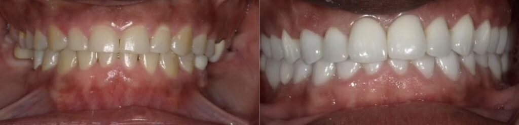 Laurel Bowie Implant and Cosmetic Dentistry | Teeth Whitening, Dentures and Implant Restorations