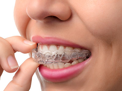 Laurel Bowie Implant and Cosmetic Dentistry | Extractions, Invisalign reg and Cosmetic Dentistry