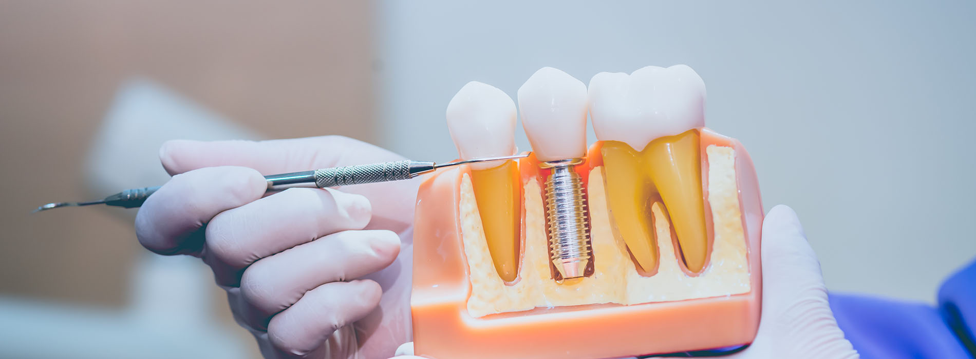 Laurel Bowie Implant and Cosmetic Dentistry | Dental Fillings, Oral Cancer Screening and Veneers